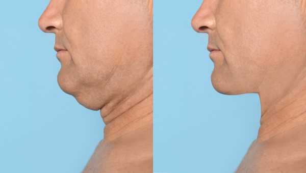 Which Non-Surgical Treatments Work Best for Jowls and Loose Skin Redhill?