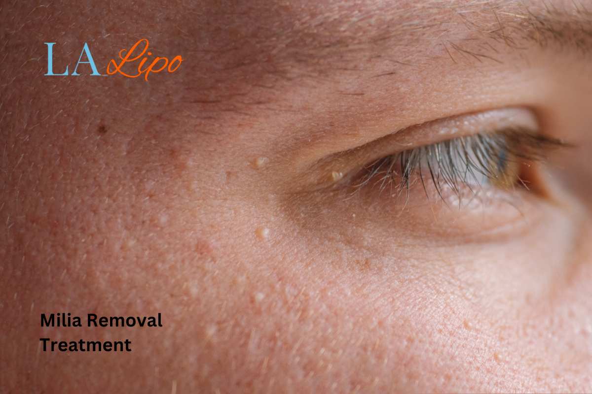 Cryopen Milia Removal: Is It the Easiest and Safest Option Redhill?