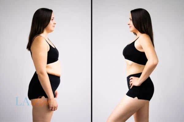 image of woman before and after results of LA-EMS Body Sculpting Redhill to help treat Diastasis recti
