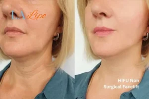 hi-fu for wrinkles Redhill before and after results