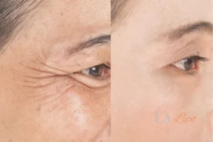 Before and after results of woman - HI-fu wrinkles reduction treatment Redhill