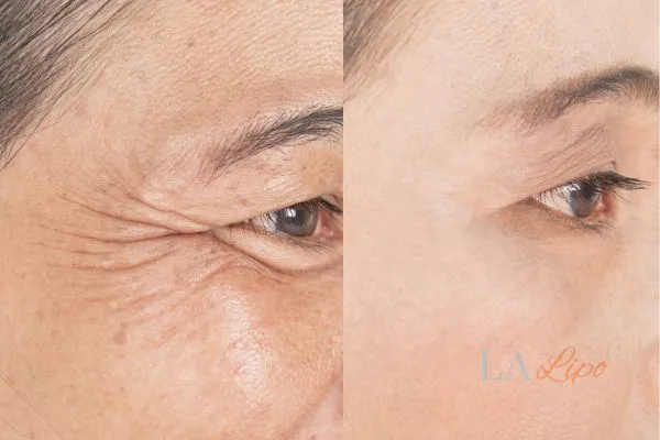 Before and after results of woman - HI-fu wrinkles reduction treatment Redhill