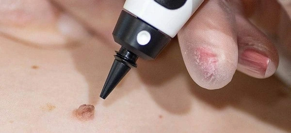 skin tag removal using cryopen Redhill