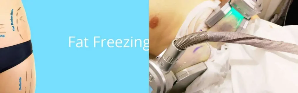 Fat freezing Redhill on multiple areas of the body