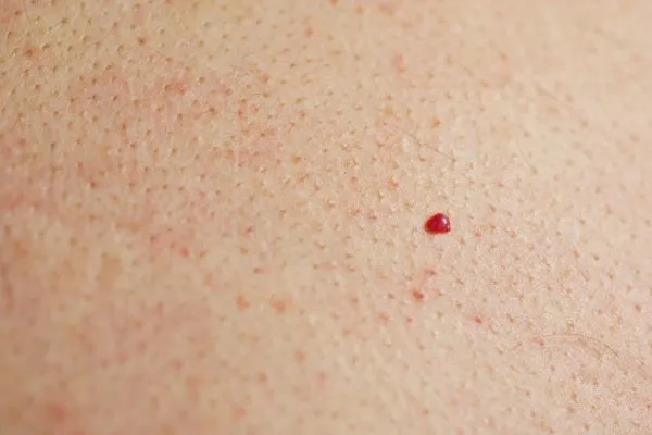 close up of a cherry angioma Redhill