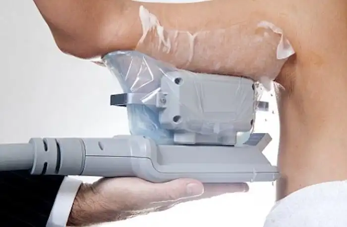Picture of fat freezing Redhill on the upper arms.
