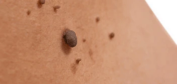 image of a skin tag Redhill