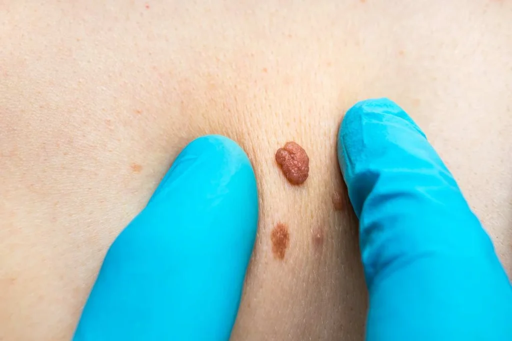 Consultant examining a skin tag Redhill