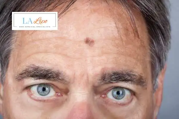 Solar Lentigo Removal Redhill image of man with mark on his forehead
