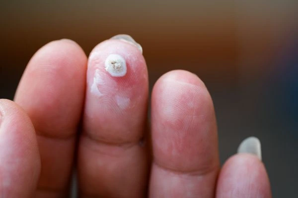 wart on person finger - cryotherapy to treat from LA LIPO Redhill