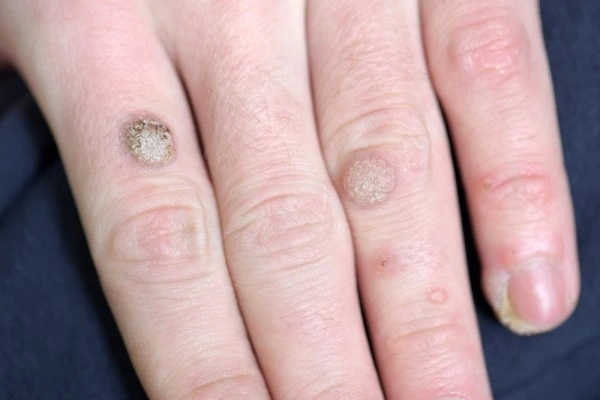 photo of warts on person hand - see wart removal Redhill from LA LIPO