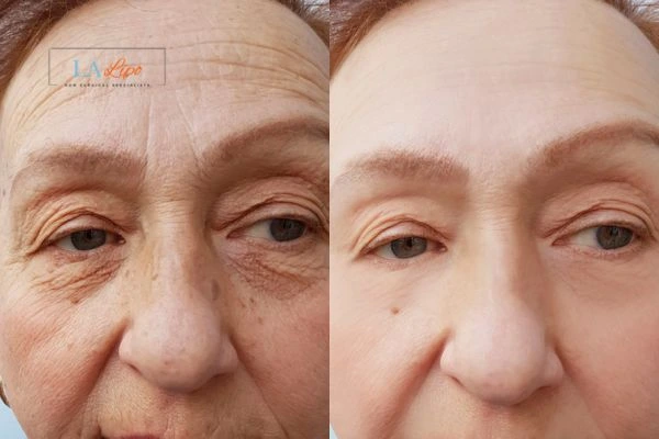The powerful benefits of Morpheus8 Treatment Redhill - Call Our team today!