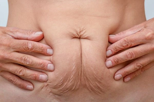 Image of a woman's stomach with loose skin - example of skin tightening Redhill options