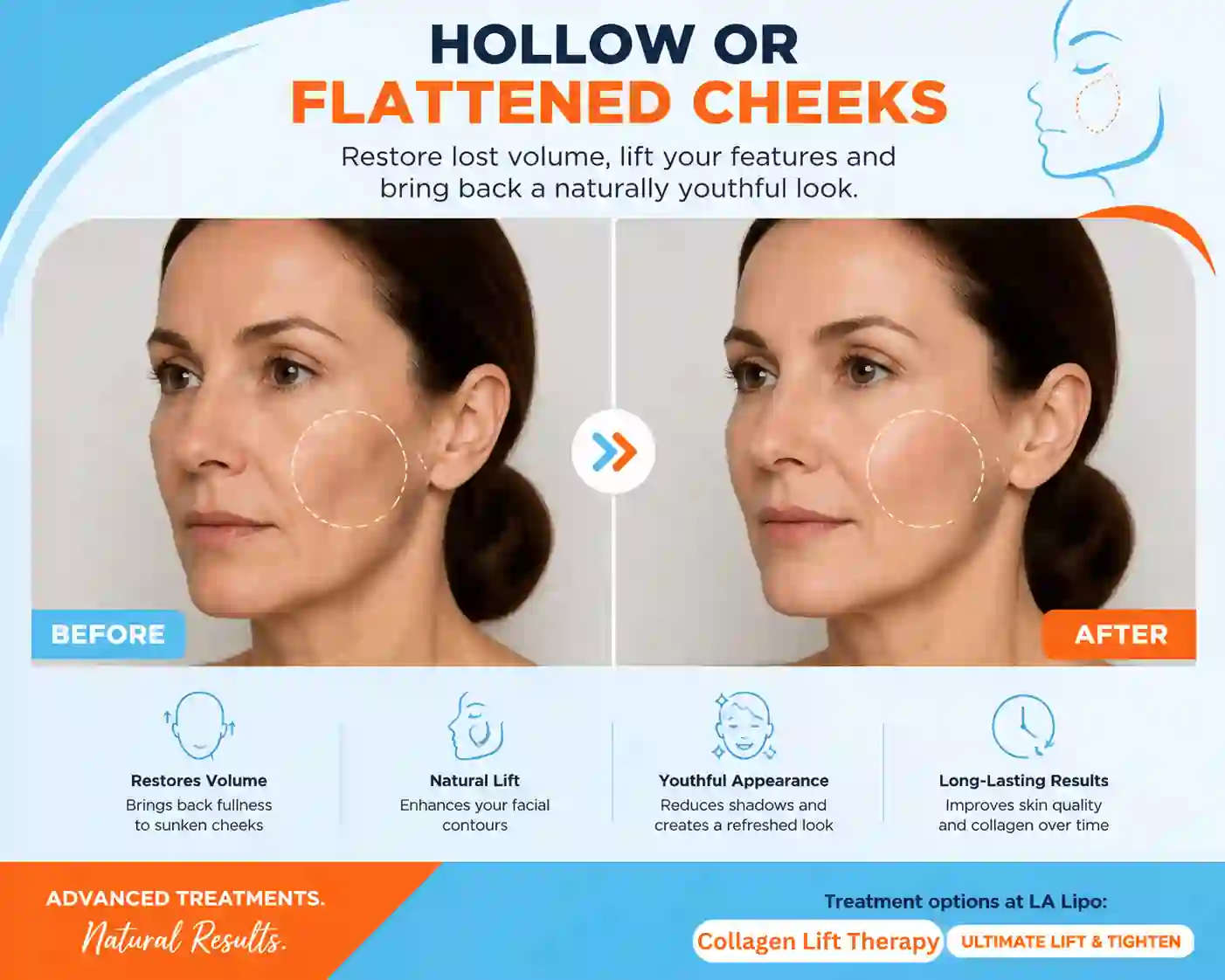 Sign #4: Hollow or Flattened Cheeks Redhill