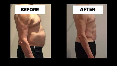 What Symptoms Can Diastasis Recti Cause in Men? Weak Core, Back Pain and Poor Posture Redhill